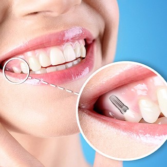 Nose-to-neck view of woman touching chin smiling with a tooth indicated as an implant