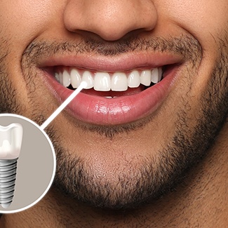 Dental implant surgery