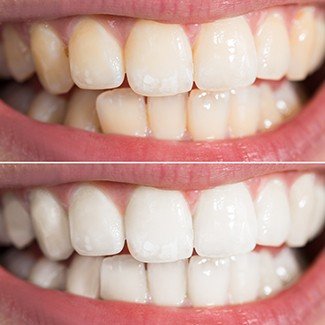 before and after of teeth whitening procedure