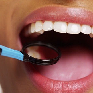 Closeup of lady's mouth being examined with dental mirror