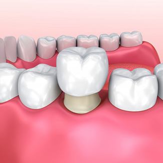 Animated dental crown being placed over bottom tooth
