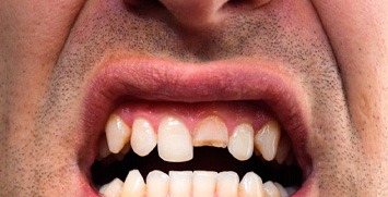 Man showing his broken tooth