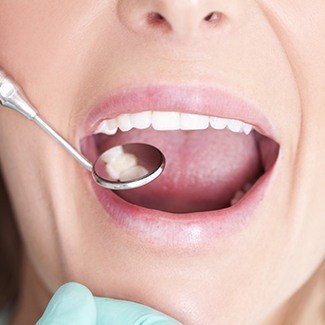 Closeup of mouth during dental exam