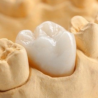 Dental crown on tooth in model of mouth