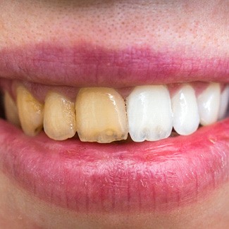 Before and after teeth whitening