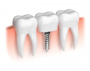 Dental implant illustration.