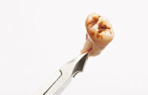 An extracted tooth that has decay